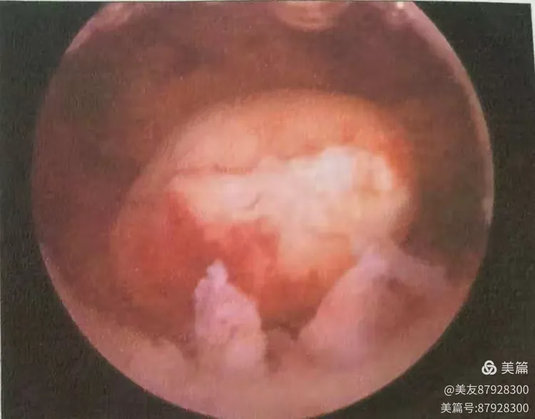 什么情况下需要做宫腔镜手术,术后需要注意什么?